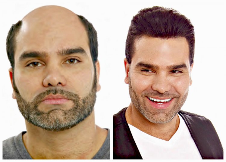 What Are The Surgical And Non-Surgical Hair Restoration Options?