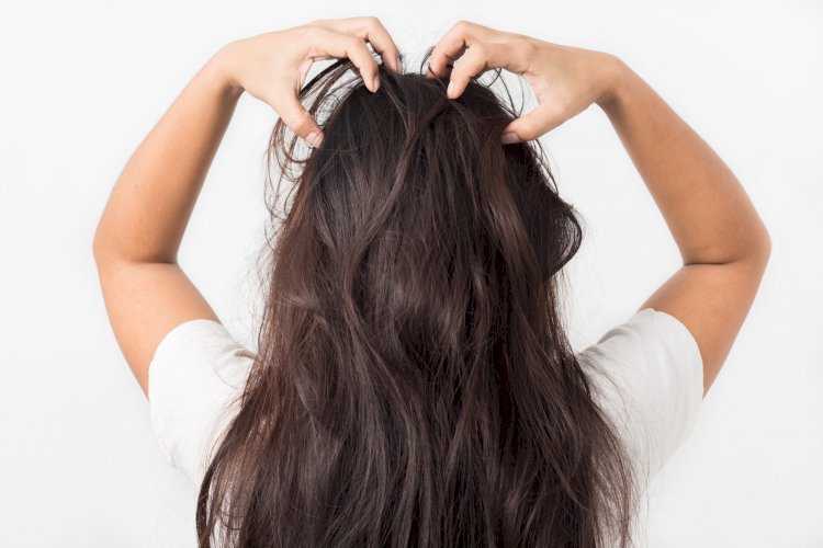 What You Need To Know About Scalp Psoriasis - Part 2