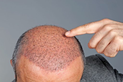 What To Expect From Hair Transplants? 