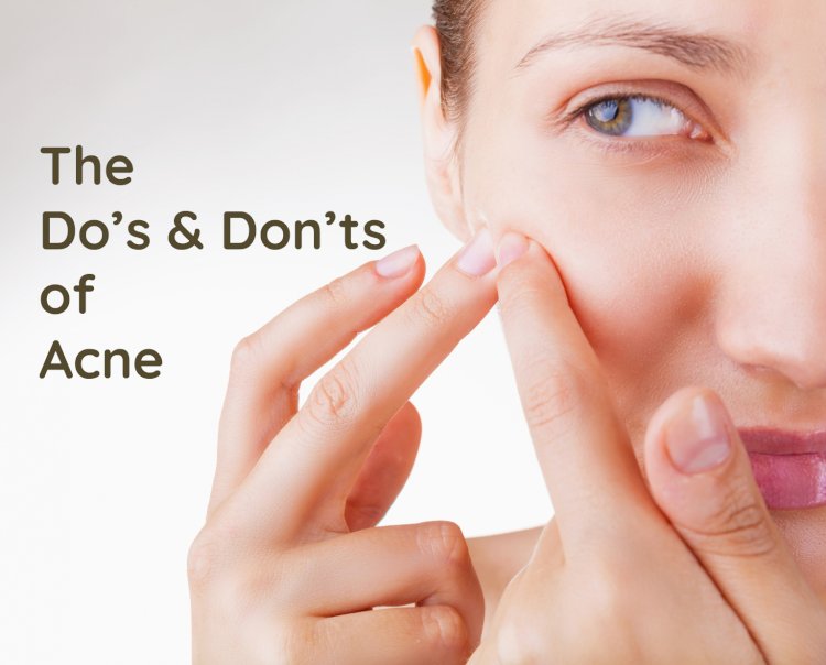 All About Acne Care: What Are The Dos And Don'ts?