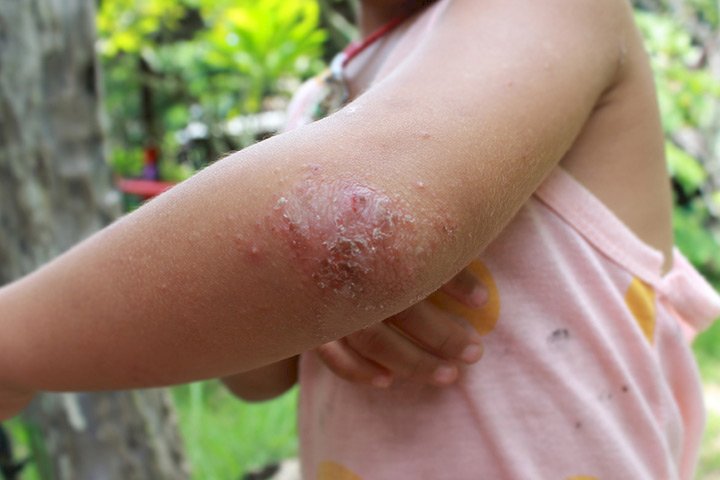 Know All That You Needed Regarding Guttate Psoriasis