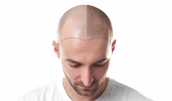 Good News For Baldness: Hair Cloning News In 2020 – When Is It Available? – Part 3 